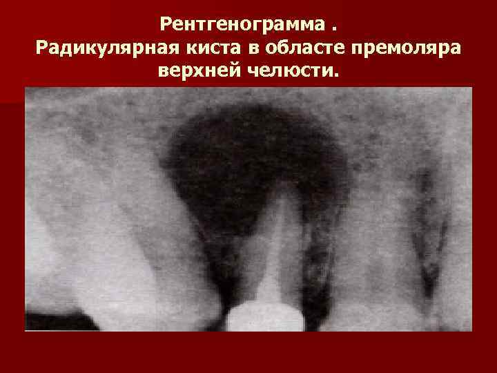 Рентгенограмма. Радикулярная киста в областе премоляра верхней челюсти. 