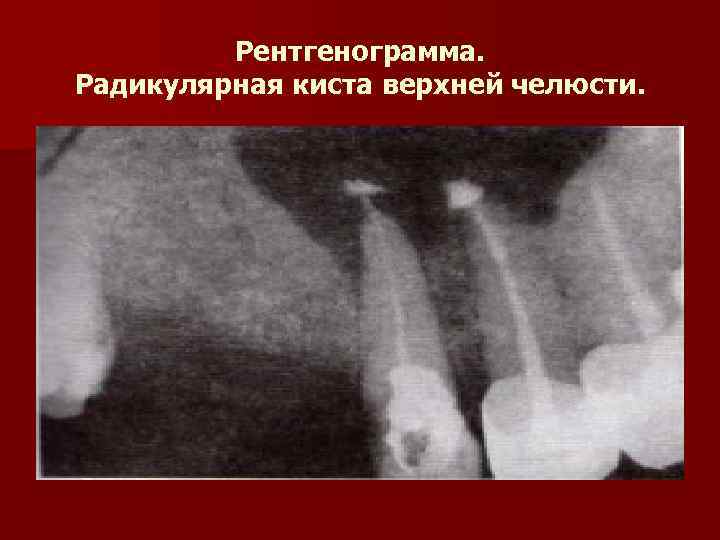 Рентгенограмма. Радикулярная киста верхней челюсти. 