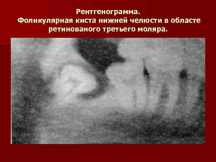 Рентгенограмма. Фоликулярная киста нижней челюсти в областе ретинованого третьего моляра. 