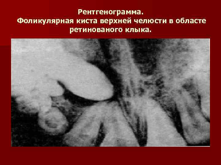 Рентгенограмма. Фоликулярная киста верхней челюсти в областе ретинованого клыка. 