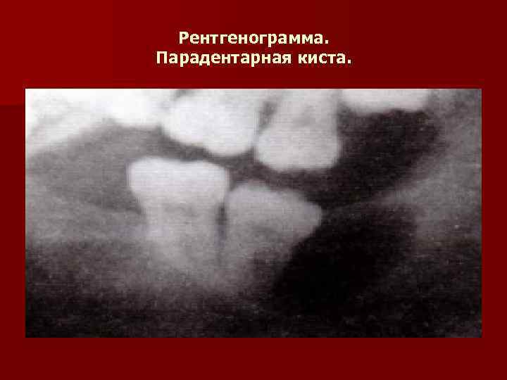 Рентгенограмма. Парадентарная киста. 