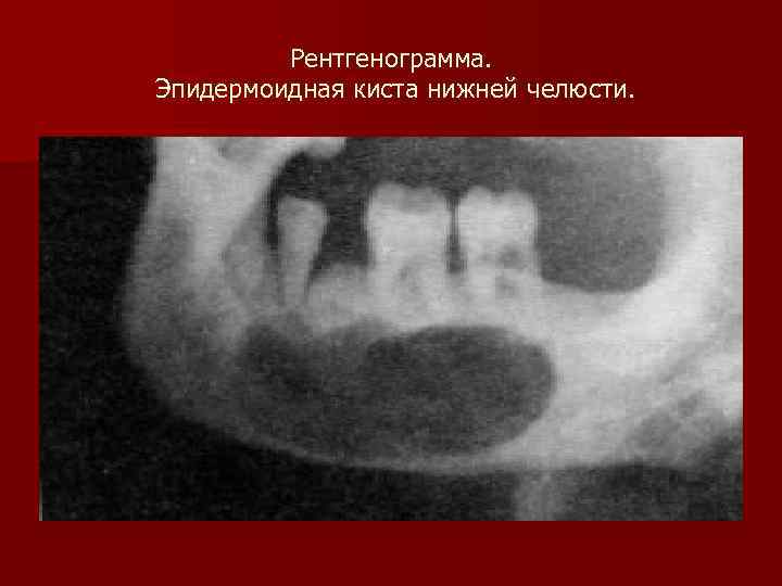 Рентгенограмма. Эпидермоидная киста нижней челюсти. 