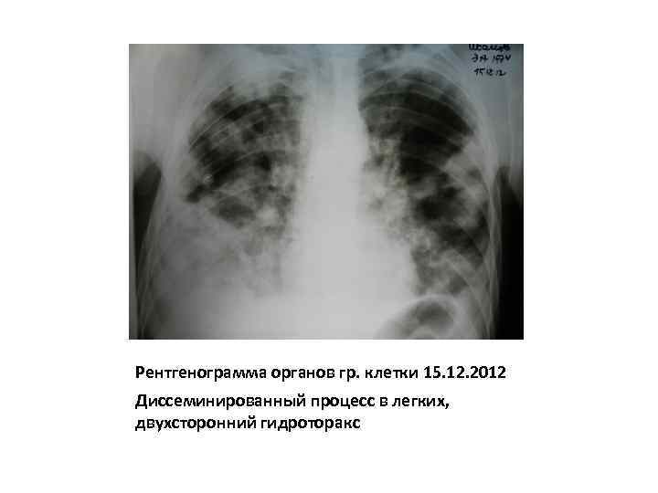 Гидроторакс форум. Мкб правосторонний гидроторакс. Двухсторонний гидроторакс. Гидроторакс на рентгенограмме.