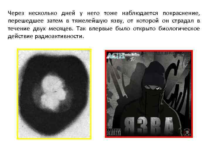 Через несколько дней у него тоже наблюдается покраснение, перешедшее затем в тяжелейшую язву, от