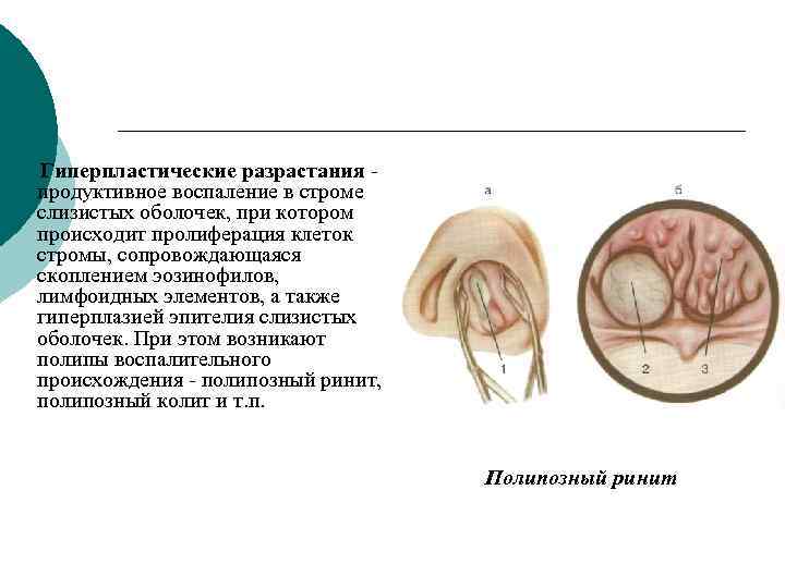  Гиперпластические разрастания - продуктивное воспаление в строме слизистых оболочек, при котором происходит пролиферация