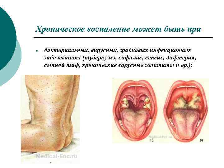 Хроническое воспаление может быть при бактериальных, вирусных, грибковых инфекционных заболеваниях (туберкулез, сифилис, сепсис, дифтерия,