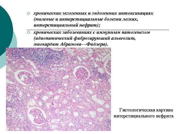 Хронический нефрит. Острый тубулоинтерстициальный нефрит гистология. Интерстициальный нефрит гистология. Хронический тубулоинтерстициальный нефрит микропрепарат. Хронический интерстициальный нефрит гистология.