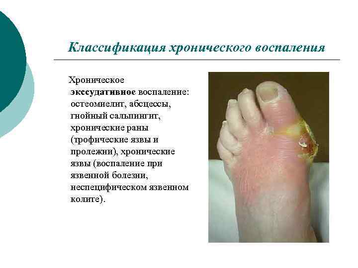 Классификация хронического воспаления Хроническое экссудативное воспаление: остеомиелит, абсцессы, гнойный сальпингит, хронические раны (трофические язвы