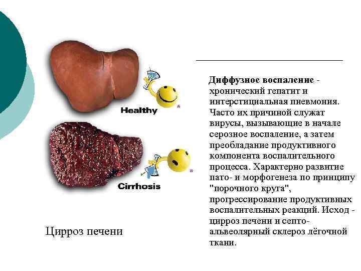 Цирроз печени Диффузное воспаление - хронический гепатит и интерстициальная пневмония. Часто их причиной служат