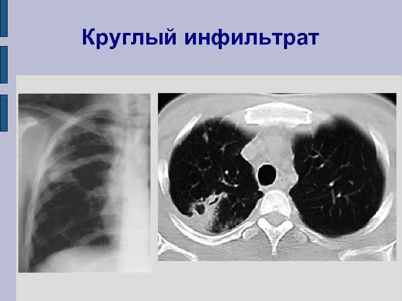 Что такое инфильтрат фото