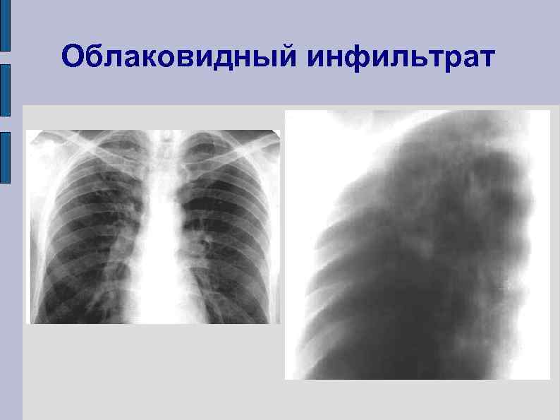 Инфильтрат при диаскинтесте фото