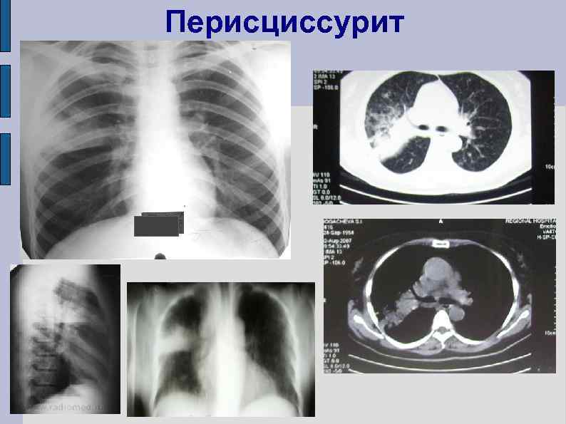 Перисциссурит 