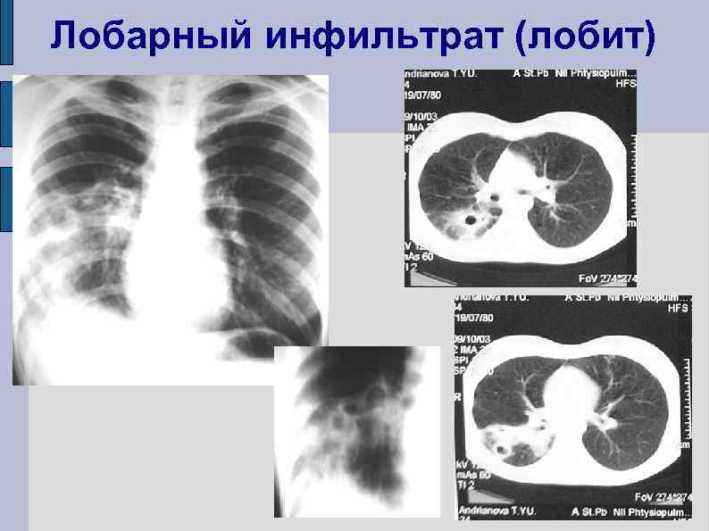 Лобарный инфильтрат (лобит) 