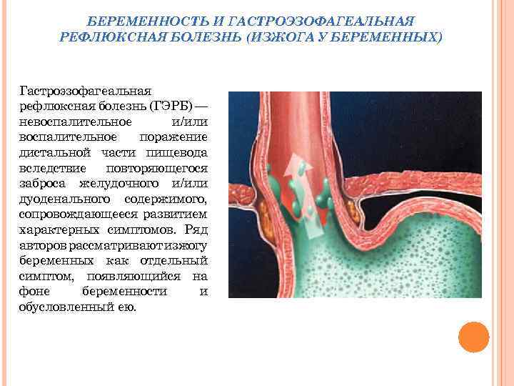 Гастроэзофагеальная рефлюксная болезнь презентация