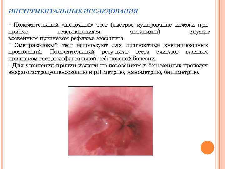 ИНСТРУМЕНТАЛЬНЫЕ ИССЛЕДОВАНИЯ · Положительный «щелочной» тест (быстрое купирование изжоги приёме всасывающихся антацидов) служит косвенным