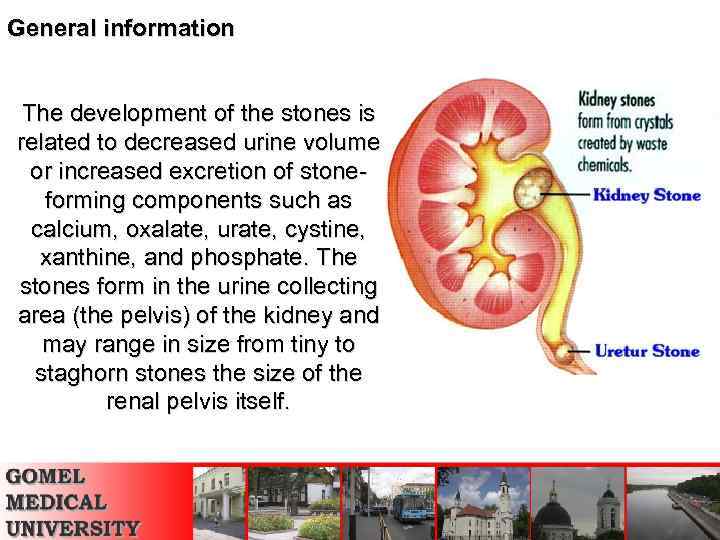 General information The development of the stones is related to decreased urine volume or