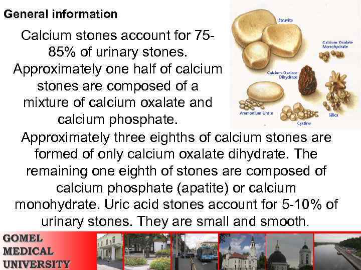 General information Calcium stones account for 7585% of urinary stones. Approximately one half of