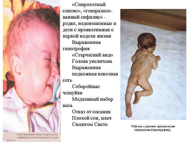  «Спирохетный сепсис» , «генерализованный сифилис» редко, недоношенные и дети с проявлениями с первой