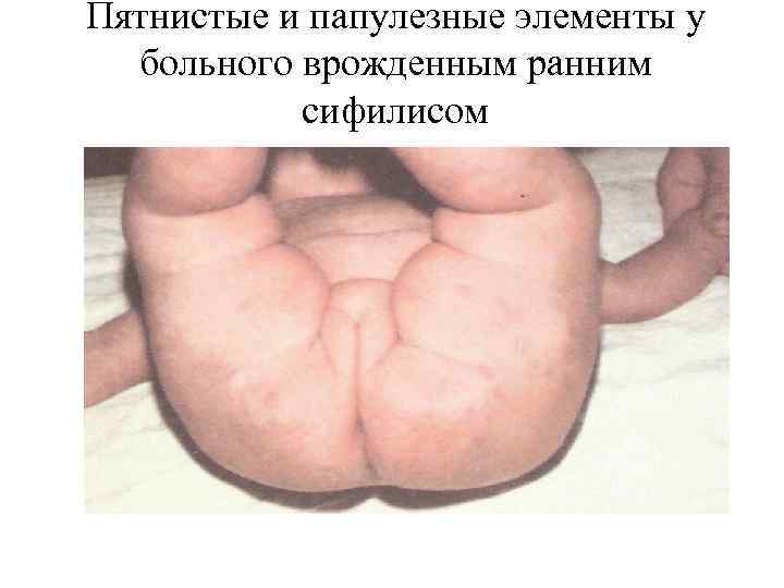 Пятнистые и папулезные элементы у больного врожденным ранним сифилисом 