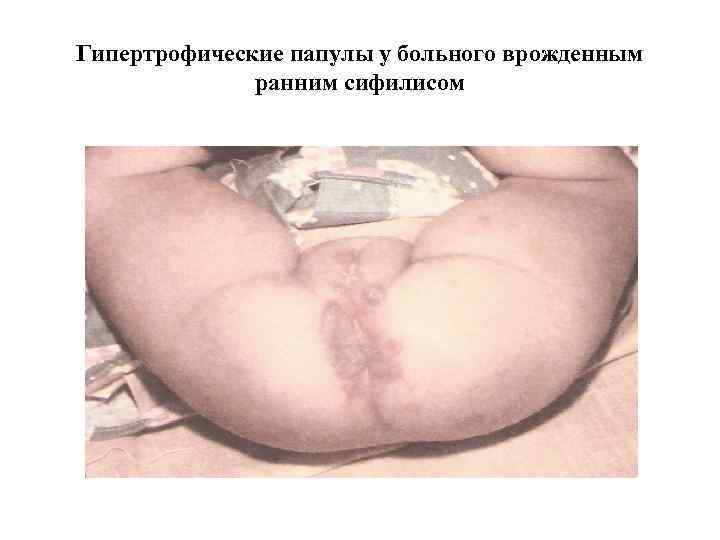 Гипертрофические папулы у больного врожденным ранним сифилисом 