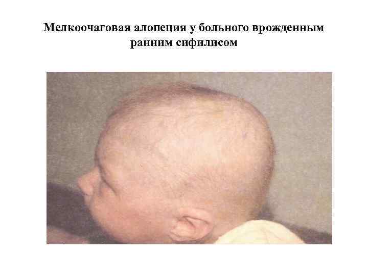 Мелкоочаговая алопеция у больного врожденным ранним сифилисом 
