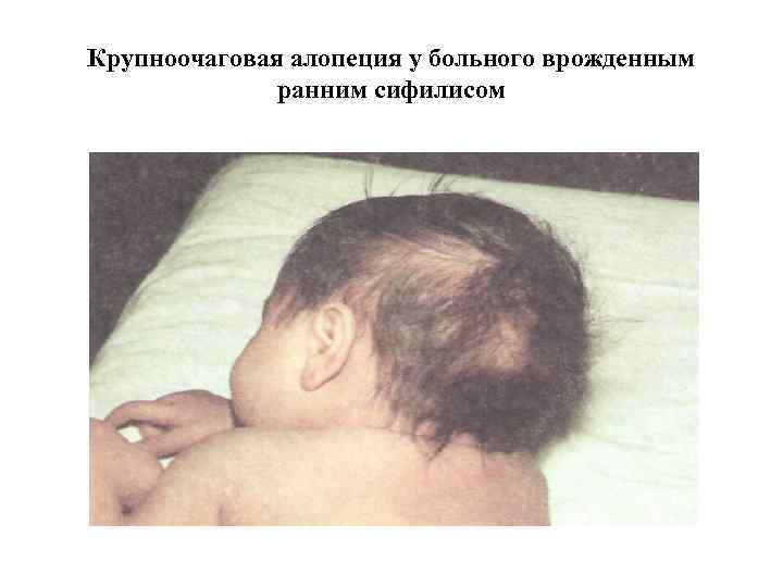 Крупноочаговая алопеция у больного врожденным ранним сифилисом 