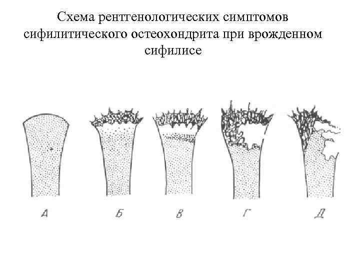 Схема рентгенологических симптомов сифилитического остеохондрита при врожденном сифилисе 