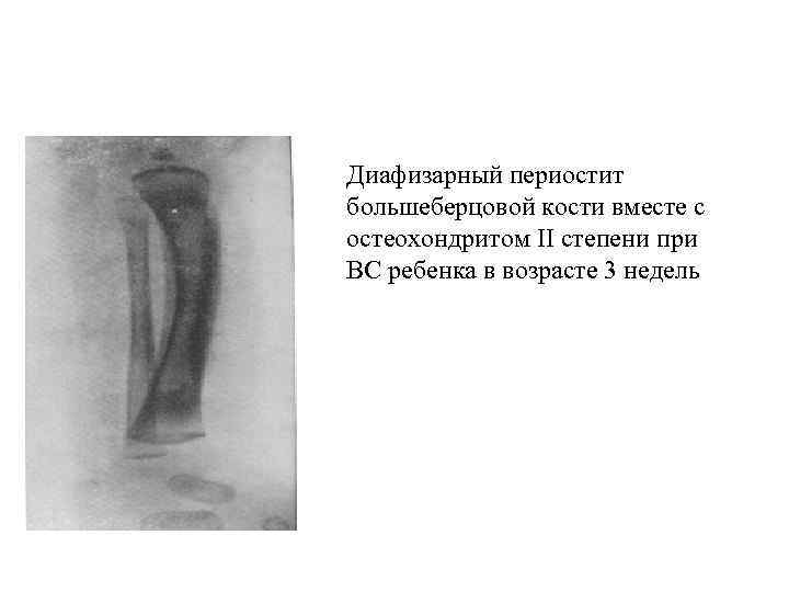 Периостит голени фото