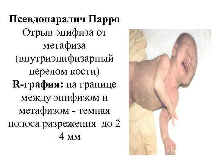 Псевдопаралич Парро Отрыв эпифиза от метафиза (внутриэпифизарный перелом кости) R-графия: на границе между эпифизом