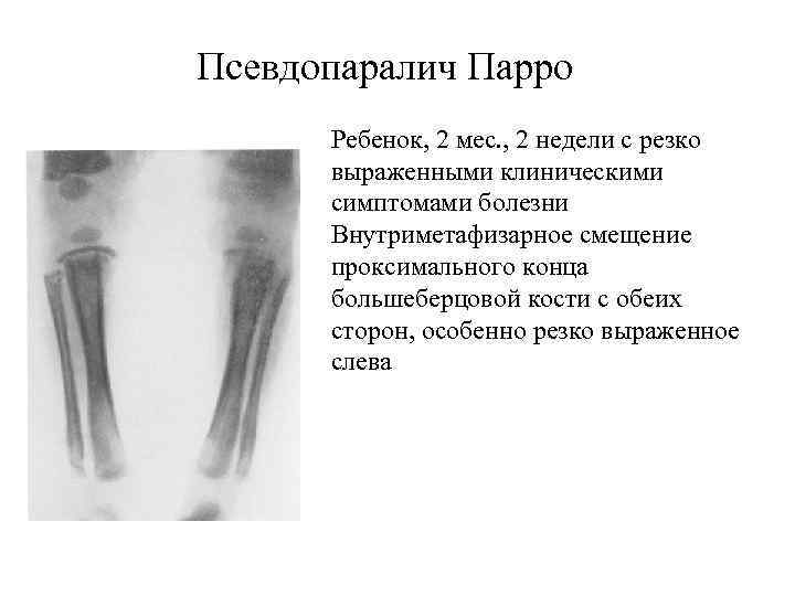 Псевдопаралич Парро Ребенок, 2 мес. , 2 недели с резко выраженными клиническими симптомами болезни