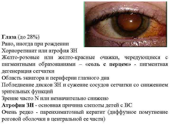 Глаза (до 28%) Рано, иногда при рождении Хориоретинит или атрофия ЗН Желто-розовые или желто-красные