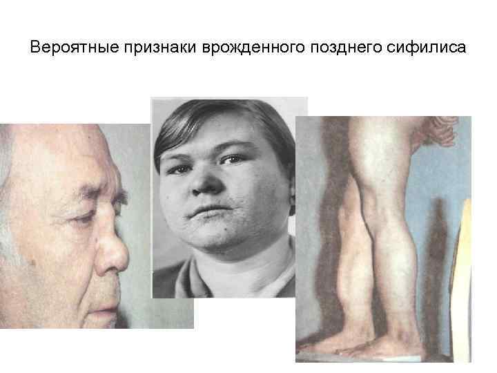 Вероятные признаки врожденного позднего сифилиса 