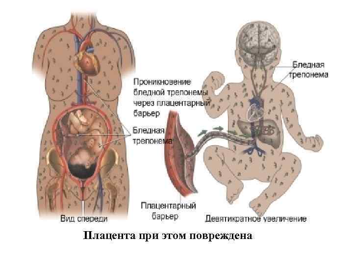 Плацента при этом повреждена 