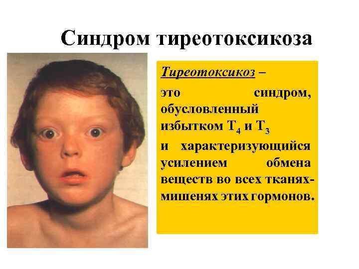 Синдром тиреотоксикоза Тиреотоксикоз – это синдром, обусловленный избытком Т 4 и Т 3 и
