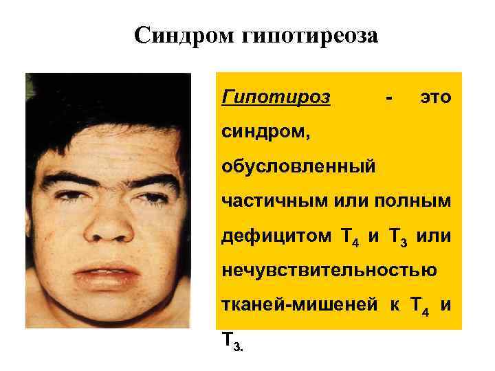 Синдром гипотиреоза Гипотироз - это синдром, обусловленный частичным или полным дефицитом Т 4 и