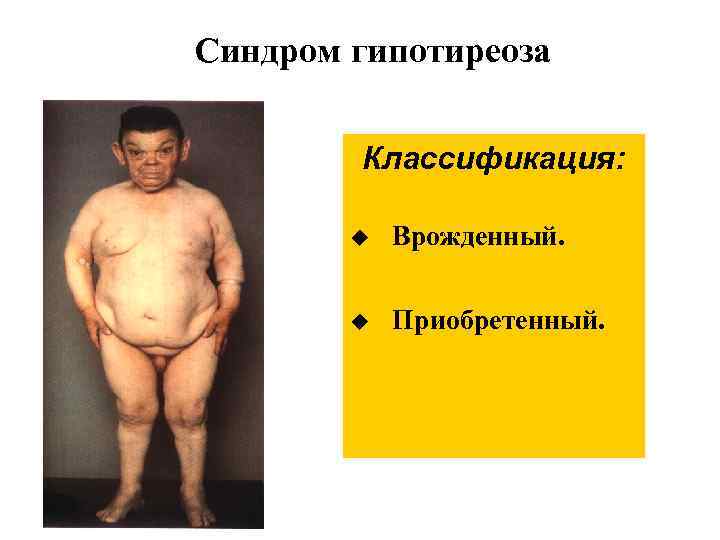 Синдром гипотиреоза Классификация: u Врожденный. u Приобретенный. 