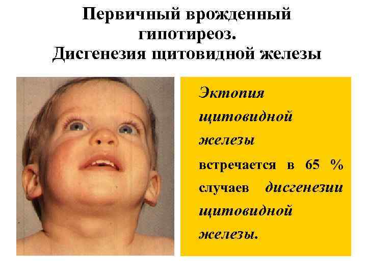 Первичный врожденный гипотиреоз. Дисгенезия щитовидной железы Эктопия щитовидной железы встречается в 65 % случаев