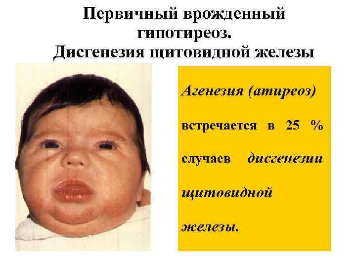 Первичный врожденный гипотиреоз. Дисгенезия щитовидной железы Агенезия (атиреоз) встречается в 25 % случаев дисгенезии