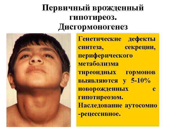 Первичный врожденный гипотиреоз. Дисгормоногенез Генетические дефекты синтеза, секреции, периферического метаболизма тиреоидных гормонов выявляются у