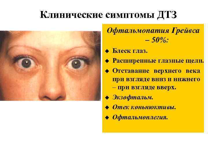 Клинические симптомы ДТЗ Офтальмопатия Грейвса – 50%: u u u Блеск глаз. Расширенные глазные