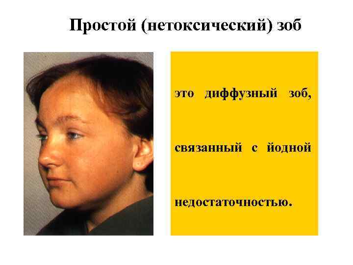 Простой (нетоксический) зоб это диффузный зоб, связанный с йодной недостаточностью. 