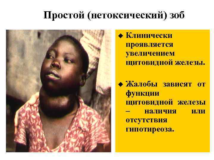 Простой (нетоксический) зоб u Клинически проявляется увеличением щитовидной железы. u Жалобы зависят от функции