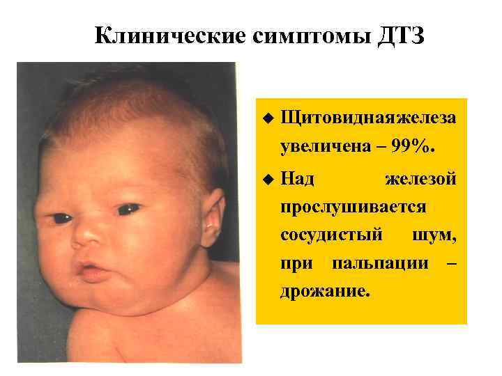 Клинические симптомы ДТЗ u Щитовидная железа увеличена – 99%. u Над железой прослушивается сосудистый