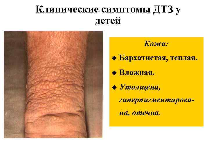 Клинические симптомы ДТЗ у детей Кожа: u Бархатистая, теплая. u Влажная. u Утолщена, гиперпигментирована,