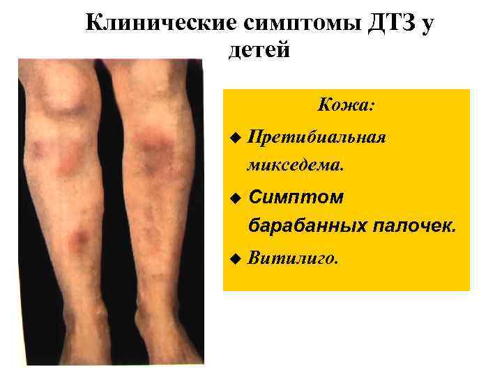 Клинические симптомы ДТЗ у детей Кожа: u Претибиальная микседема. u Симптом барабанных палочек. u