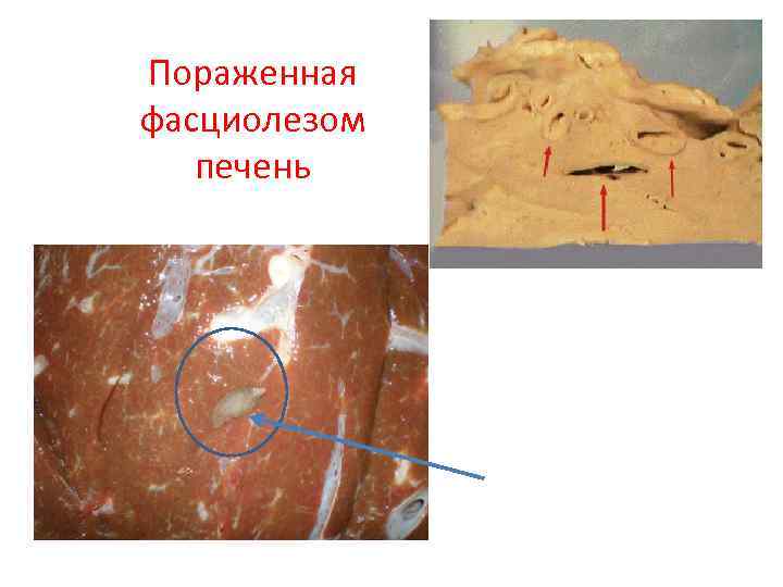 Пораженная фасциолезом печень 