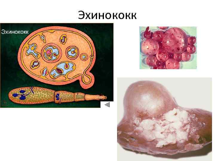 Эхинококк 