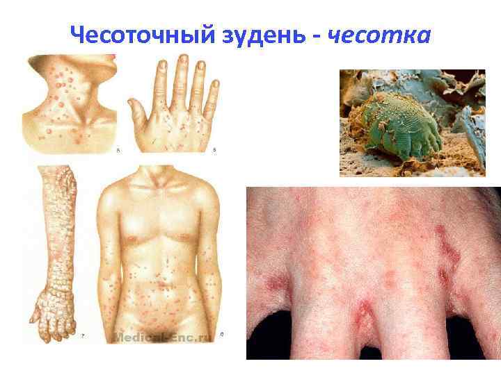 Чесоточный зудень - чесотка 