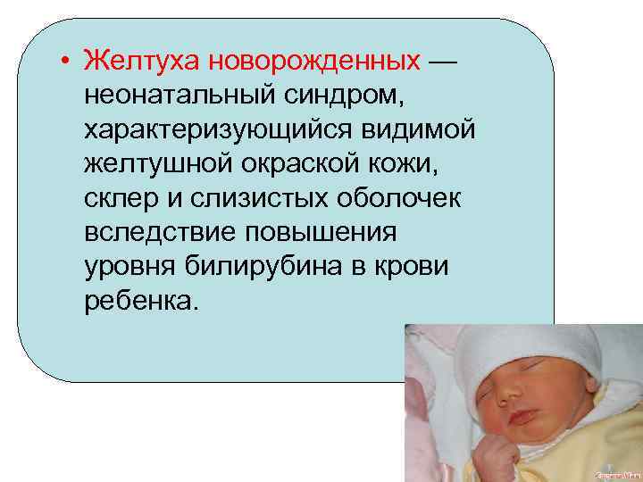 Желтушный синдром у новорожденных презентация