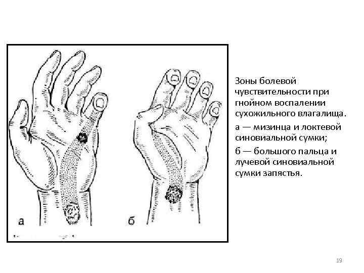 Зоны болевой чувствительности при гнойном воспалении сухожильного влагалища. а — мизинца и локтевой синовиальной